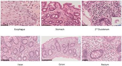 Potential association between M694V homozygous mutation in familial Mediterranean fever and eosinophilic intestinal inflammation: a pediatric case series